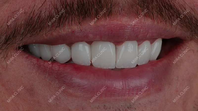 Hollywood smile for men 